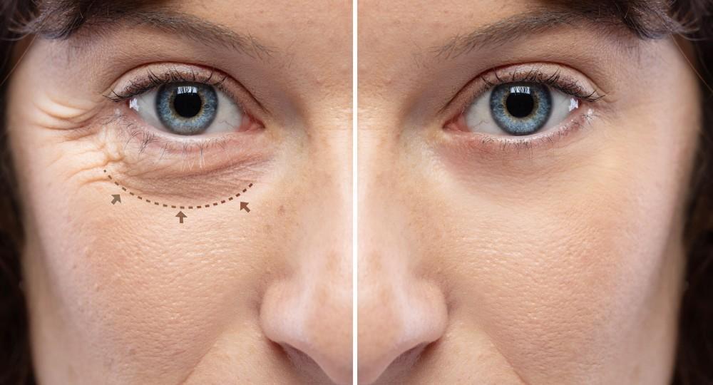 A lower eyelid surgery before and after result, showing elimination of under-eye bags