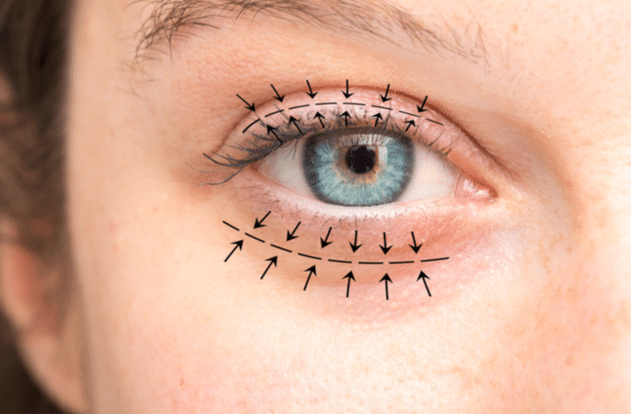 An illustration showing the areas corrected by blepharoplasty, or eyelid surgery.