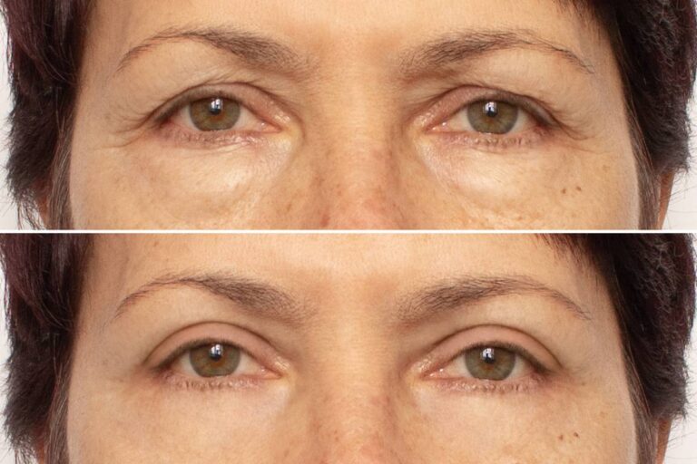 A patient using cold compresses, a key step in the eyelid surgery recovery process.